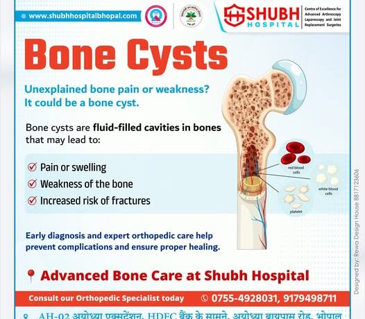 Advanced bone cyst treatment in Bhopal showing bone cyst structure