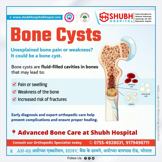 Advanced bone cyst treatment in Bhopal showing bone cyst structure